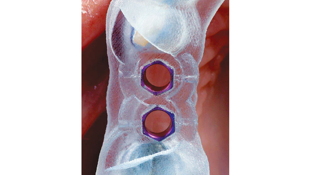 Surgical guide is placed on patient