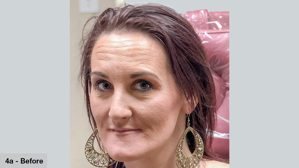 before photo of patient prior to life-changing bruxzir full-arch restoration