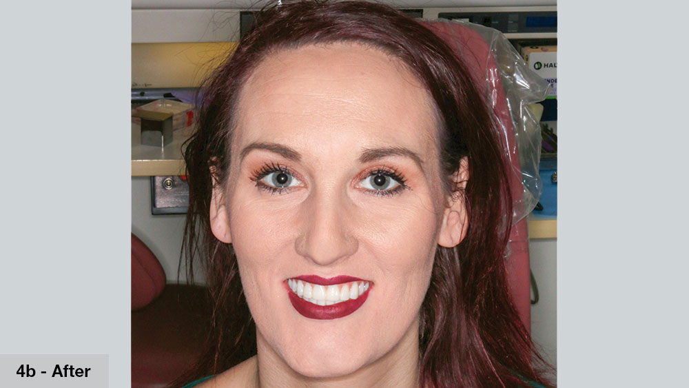 after photo of patient with bruxzir full-arch restoration