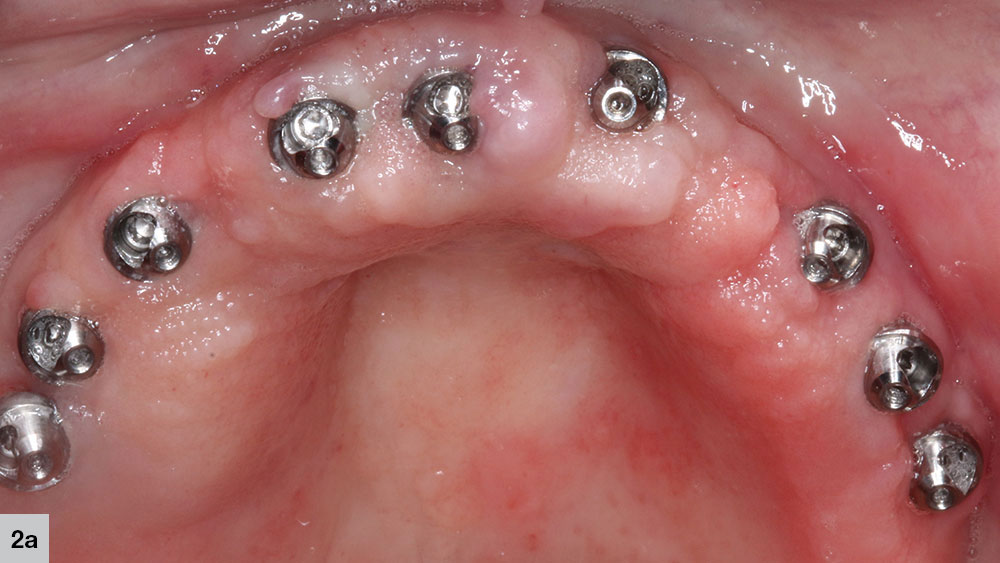 a combination of angled and straight multi-unit abutments attached to implants