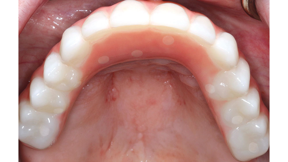 bruxzir full-arch restoration