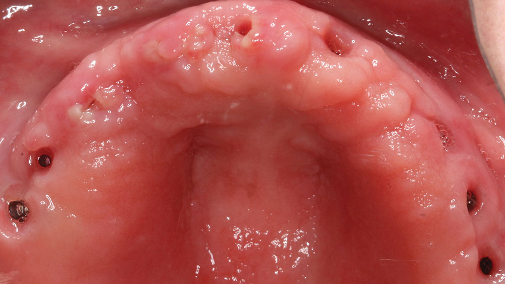 9 hahn tapered implants placed in upper arch