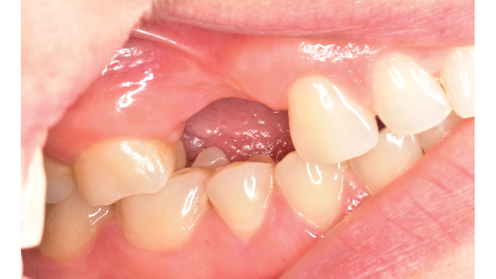 Edentulous space spanning teeth #4 and #5