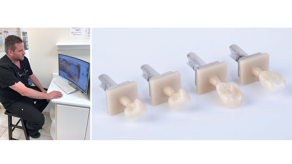 Dr. Methven and delivering same-visit BruxZir Now crowns