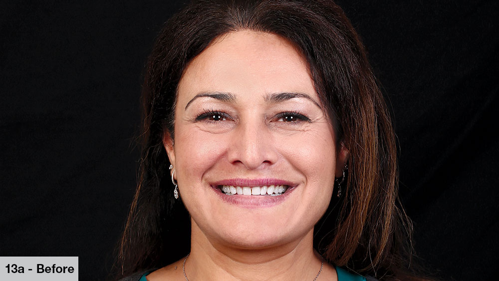 female patient photo before receiving bruxzir esthetic