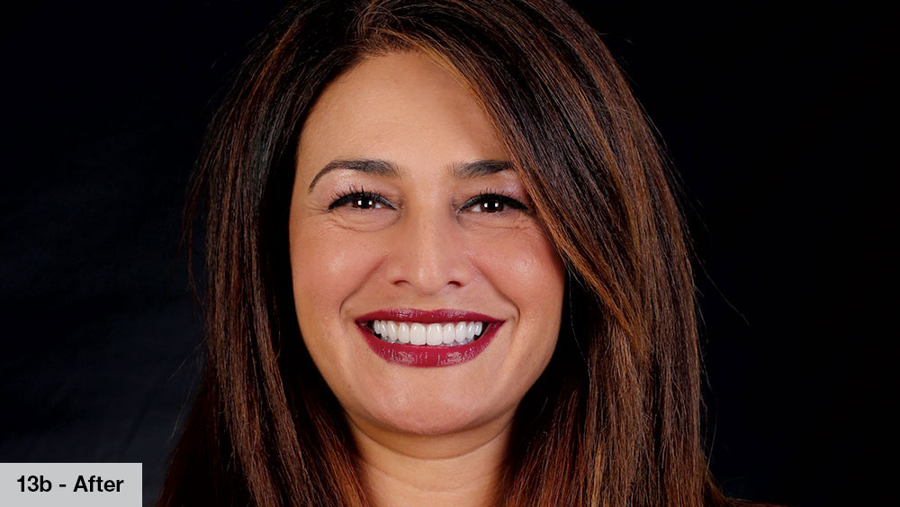 female patient photo after receiving bruxzir esthetic