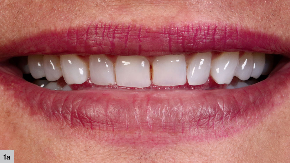 patient's interproximal composite bonding #8 and #9