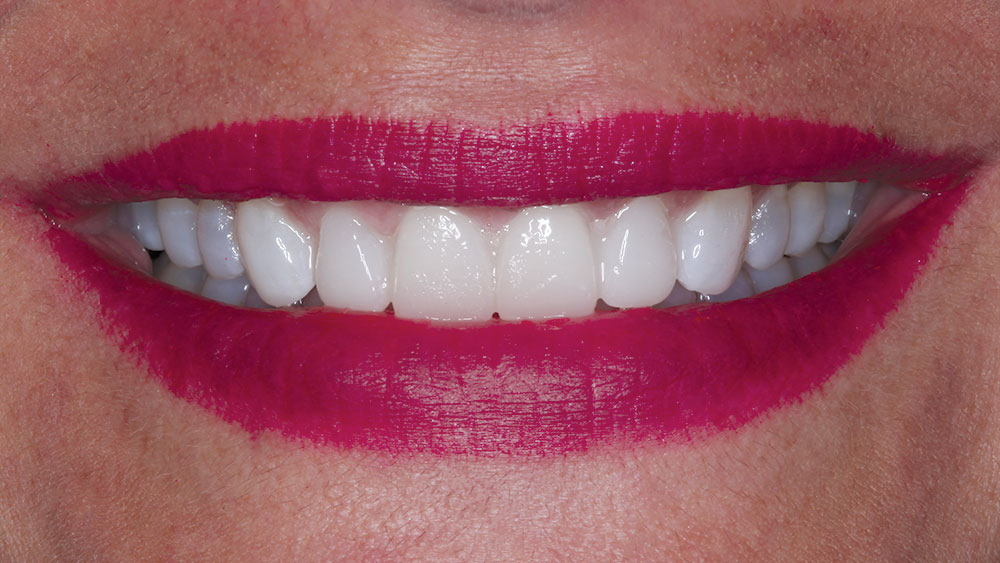 final restorations after transferring mockup