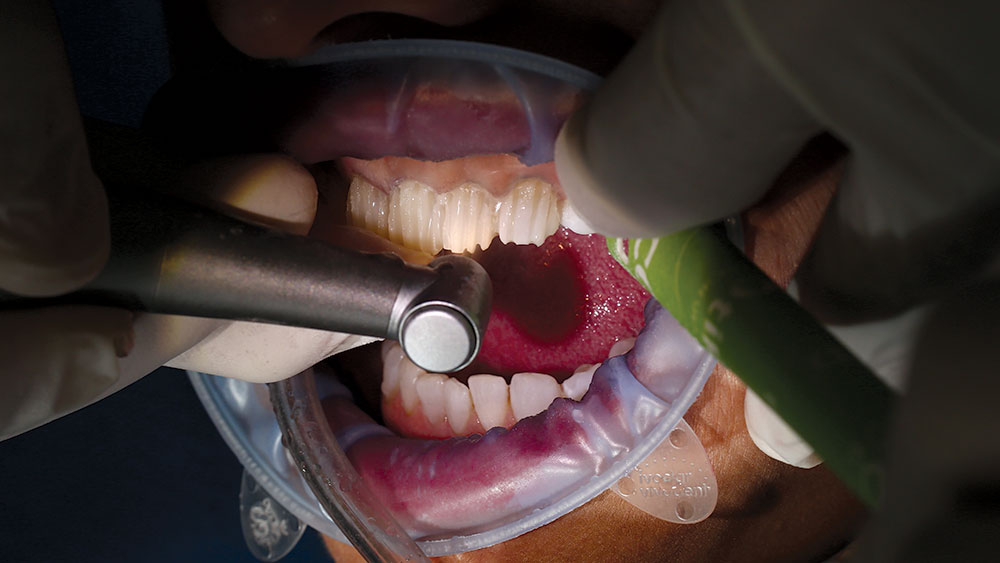 vertical cuts procedure through mockup using 0.8 mm tip of bur