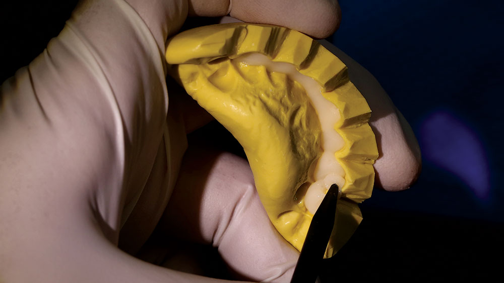 back-fill bisacryl material into a putty matrix