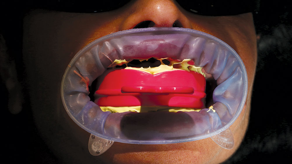 eliminary anterior, triple-tray VPS impression with Capture® impression 