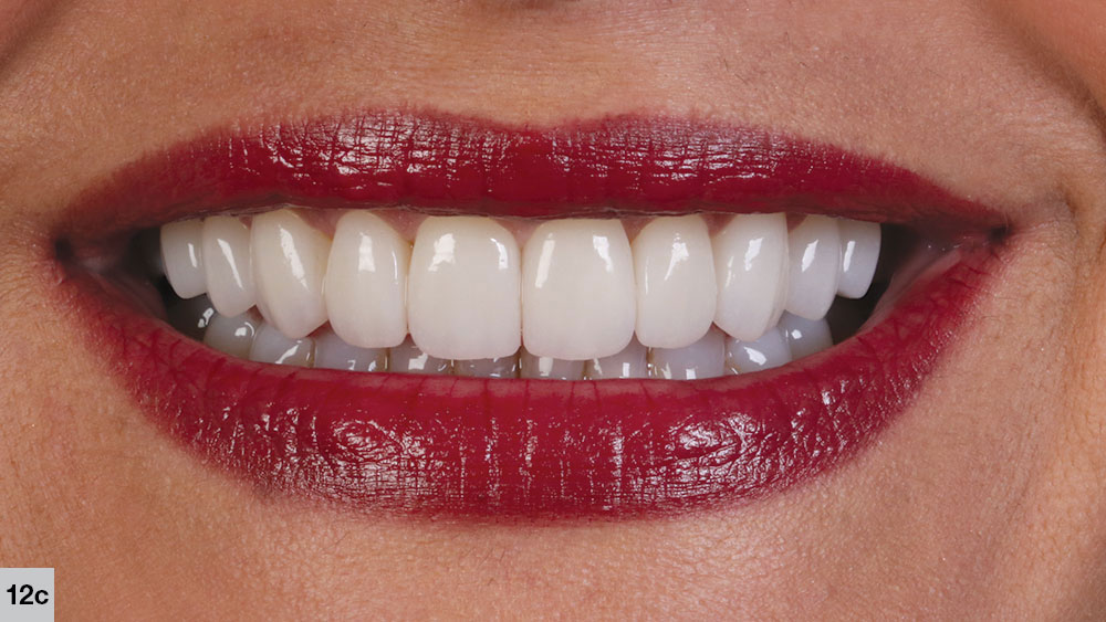 perfect smile final result