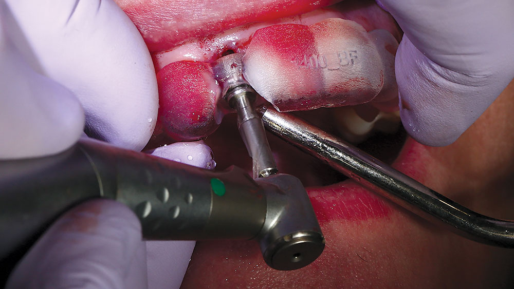 Clinician performing implant osteotomy