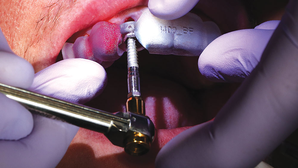 Implant direct placed through the guide