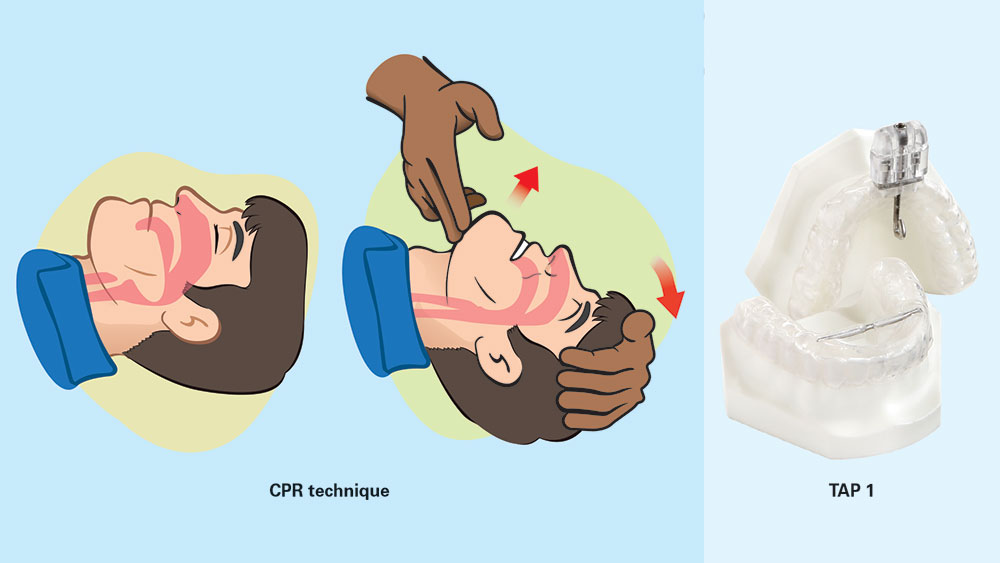 TAP 1 based on CPR technique