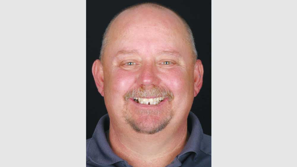  patient is extremely happy with the esthetics of the acetal partial