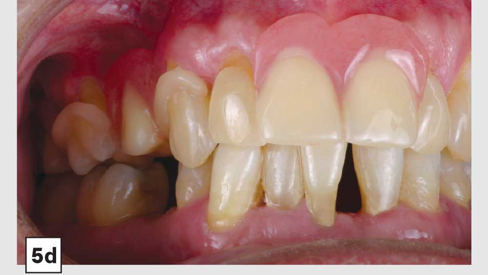 5d: patient's occlusion in a comfortable fit