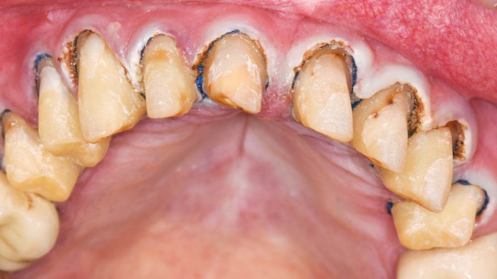 gingival tissue was lasered and cord was packed around for intraoral scan