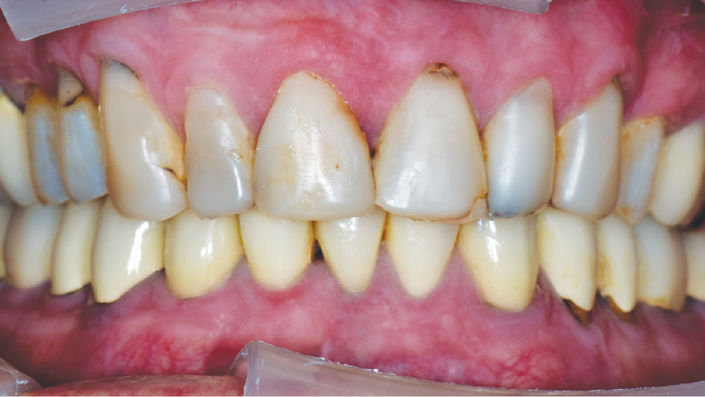 retracted facial image