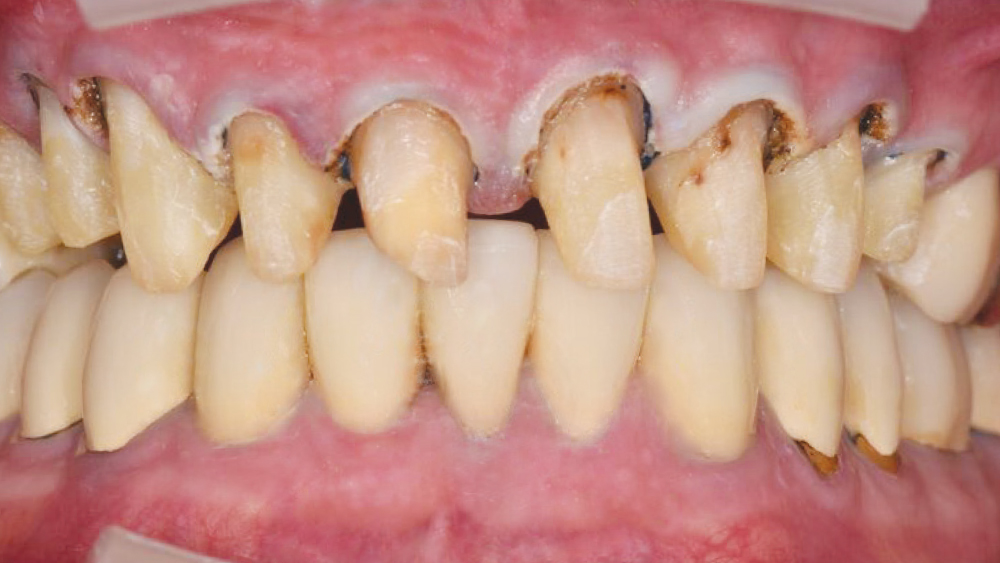 individual crowns needed for #4-12