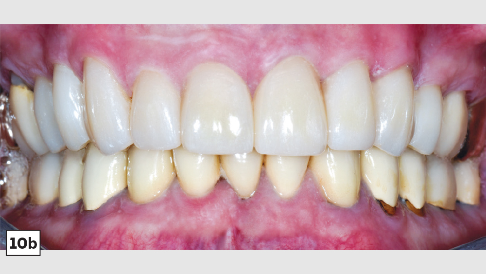 After results of patient's upper teeth