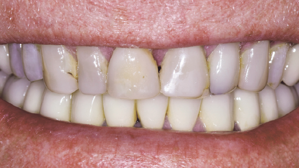 heavily worn upper denture and lower partial denture
