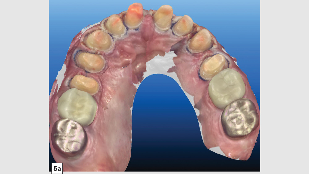 iTero Element intraoral scanner display