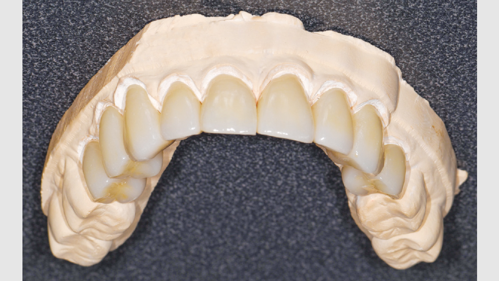 Milled BruxZir Esthetic crowns