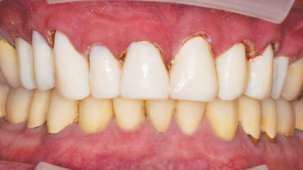 Bisacryl temporary restoration was placed