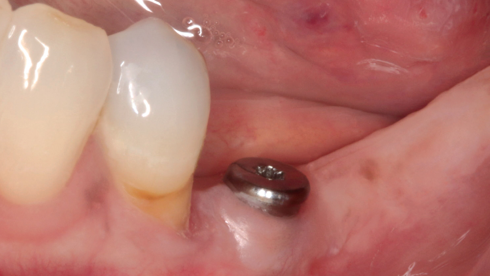 implant site after 4 months of healing