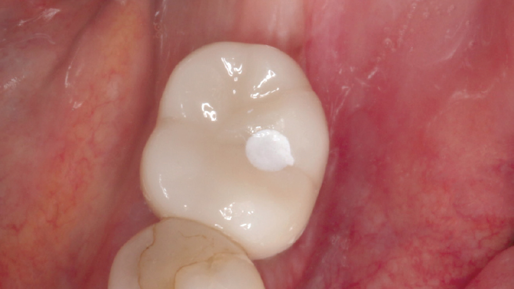 BruxZir Full-Strength screw-retained crown