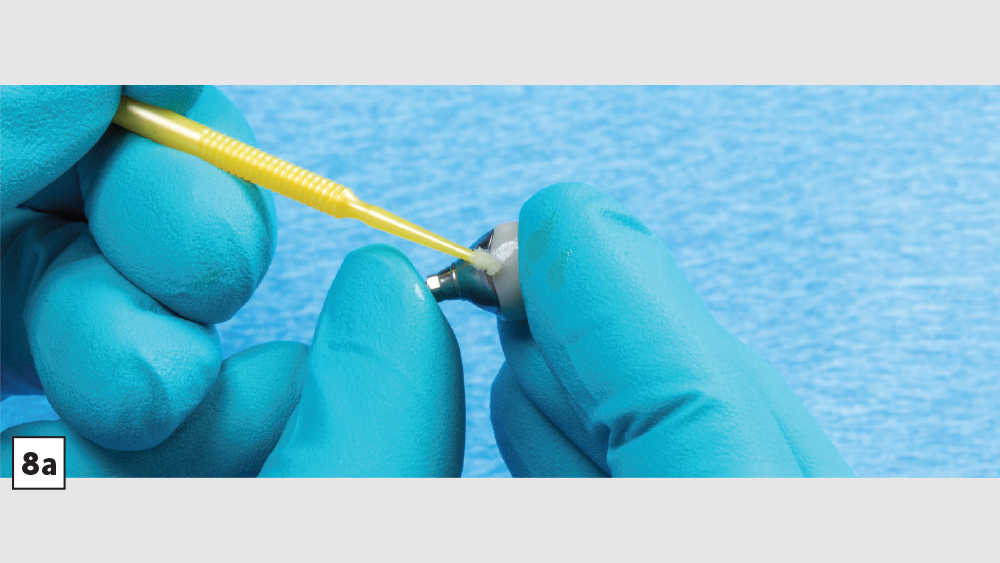 figure 8a: a microbrush cleaning away cement from margins of the custom abutment and implant crown
