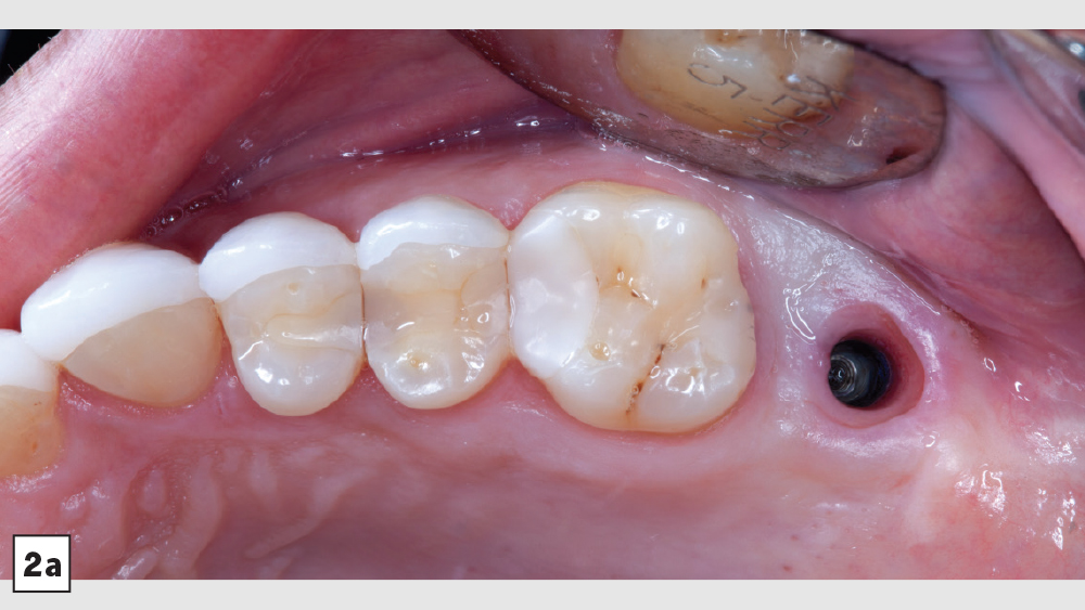 patient x-ray with existing screw-retained crown