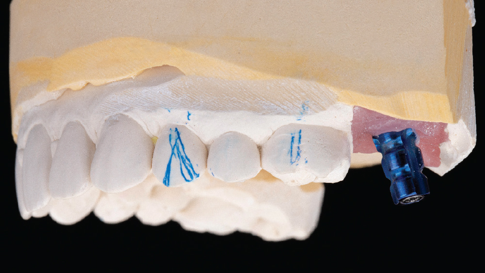 figure 3: close-tray impression sent to lab and model created with impression