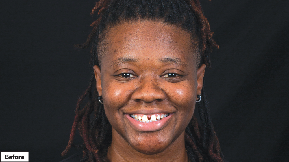 Patient before Smile Transitions