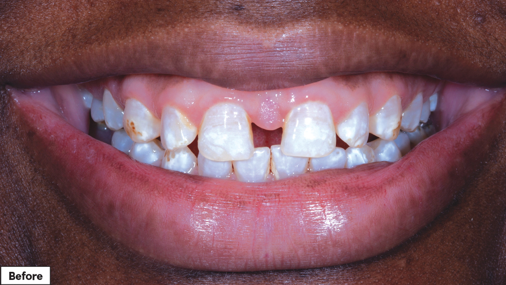 Patient's smile before Smile Transitions