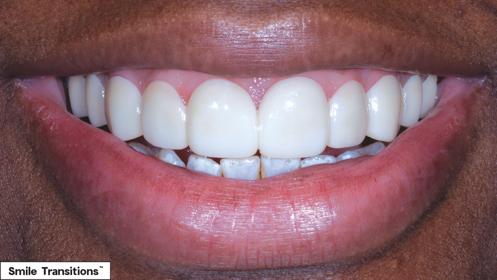 Patient's smile after Smile Transitions