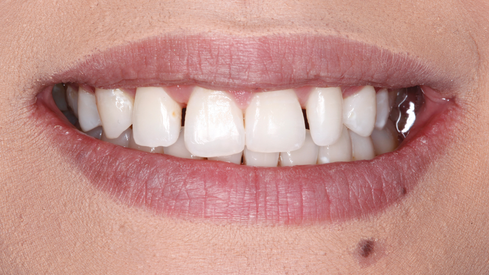 Direct Composite Veneers Figure 1B