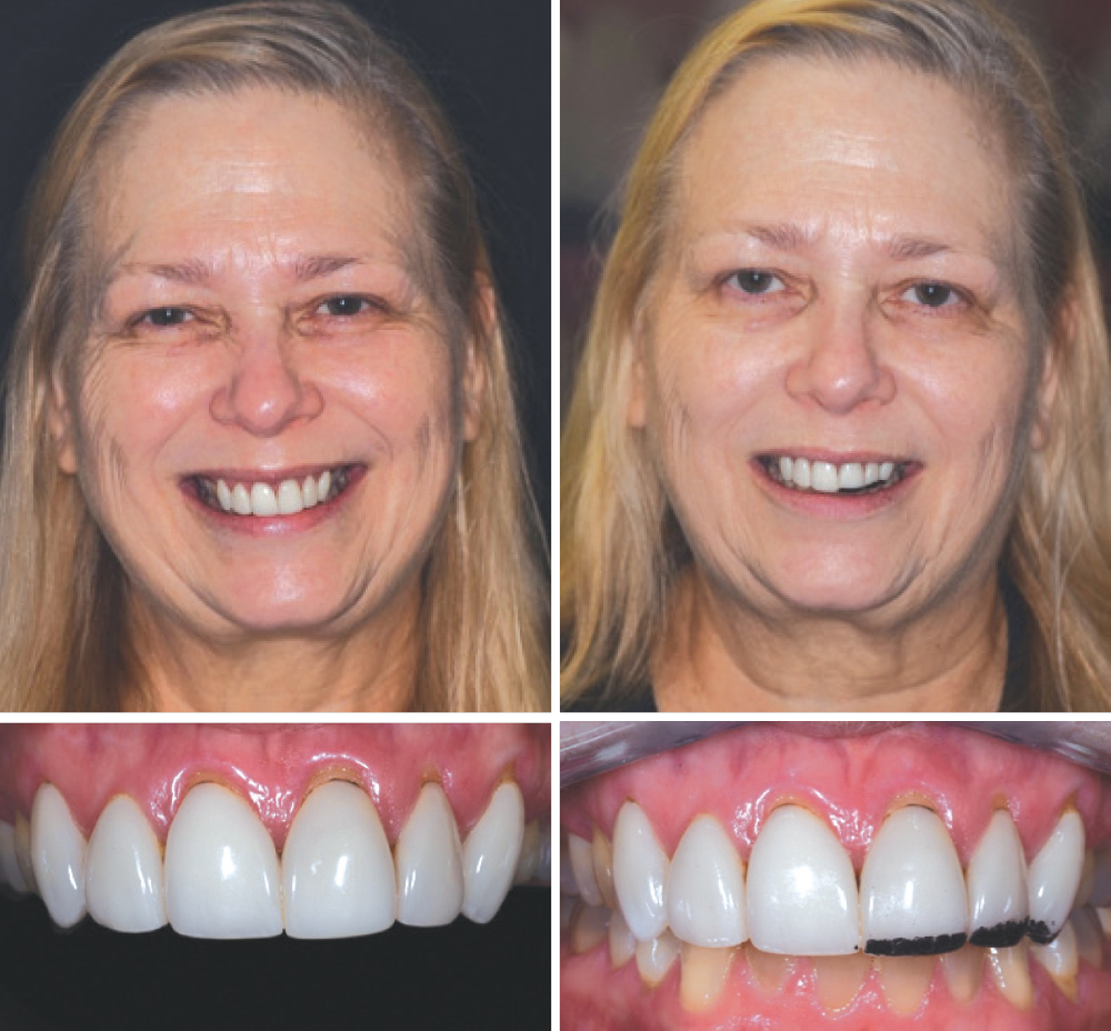 REDUCING THE LENGTH OF THE CENTRALS