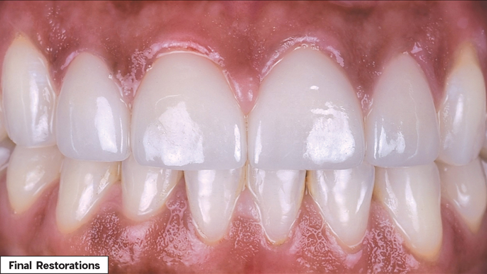 Final restorations after Biotemps