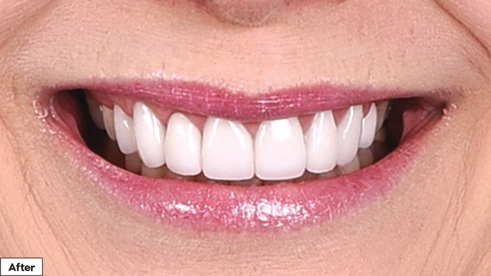 REDUCING THE LENGTH OF THE CENTRALS