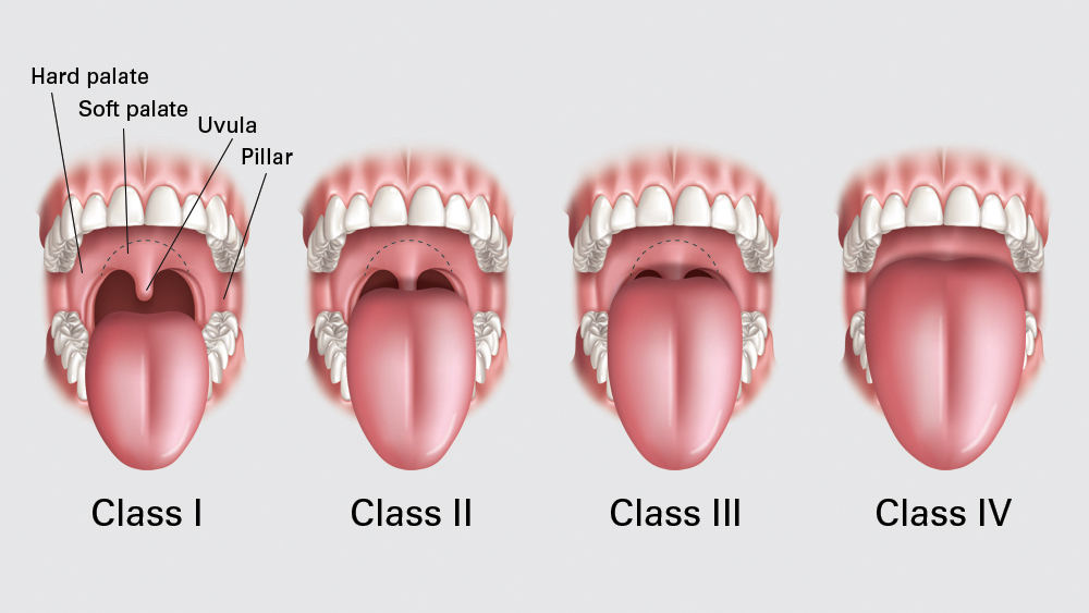 Class I-IV of mallampati classifications