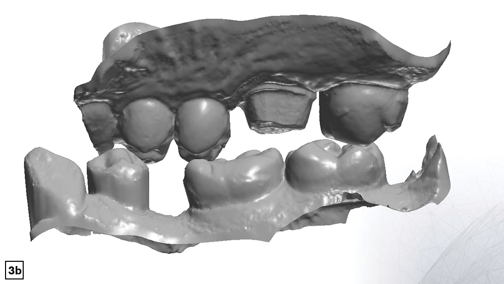 Cheeks and tongue interference leads to missing data of impression