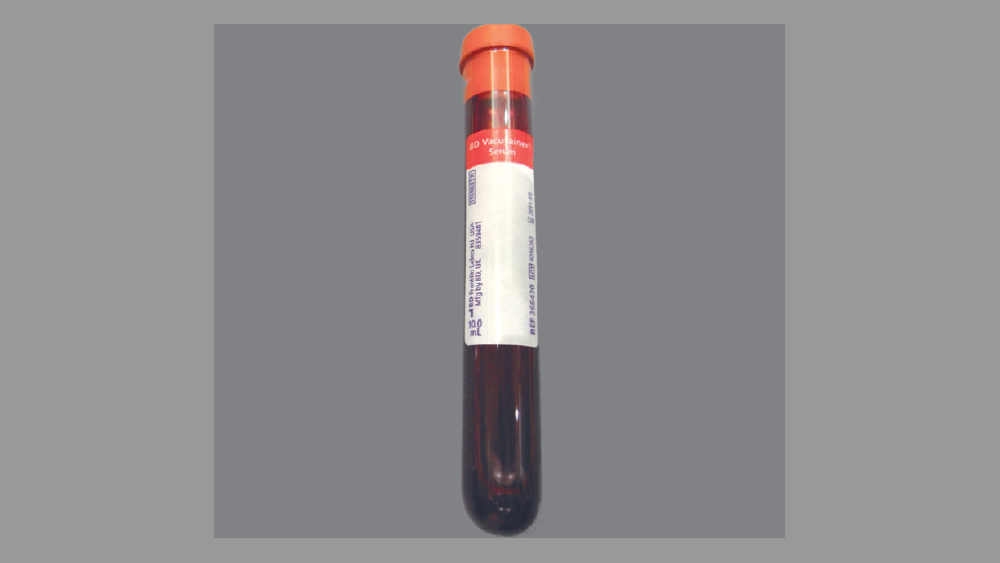 Blood sample in vial