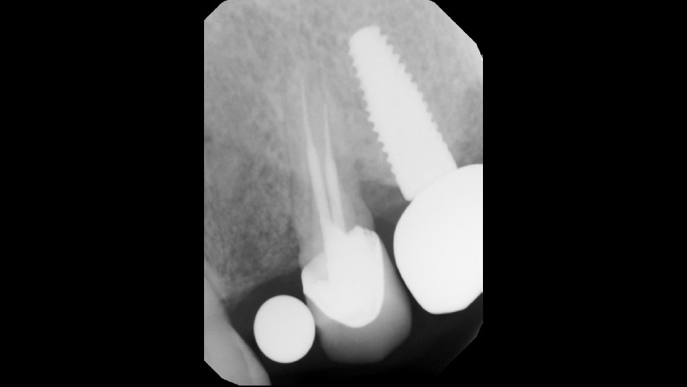 CBCT analysis of edentulous sites