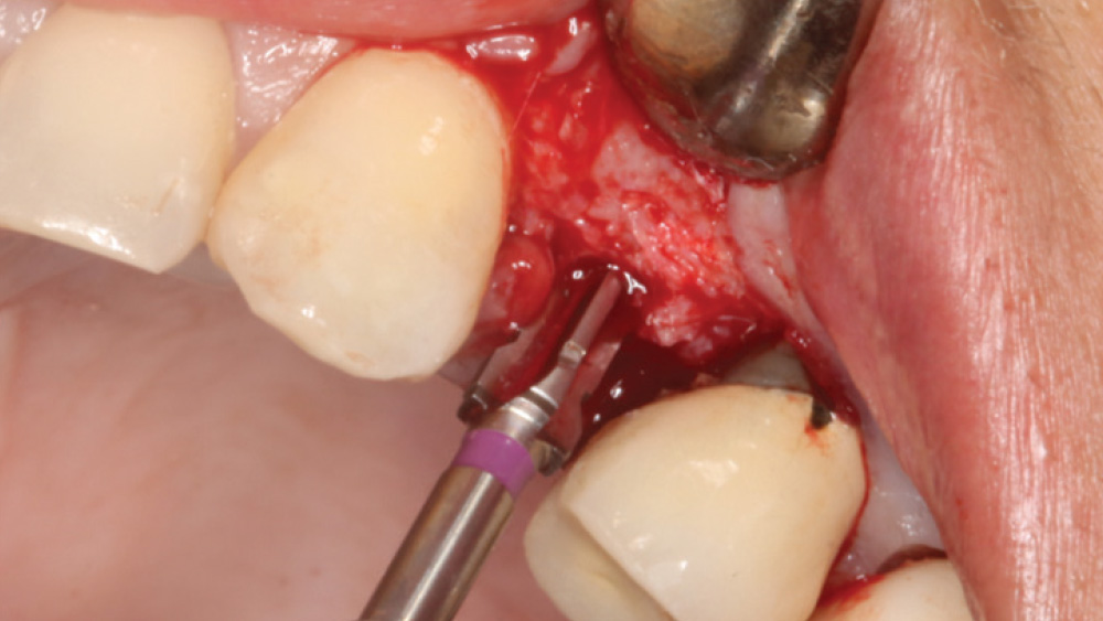 Close-up of each osteotomy widened using a straightforward series of shaping drills