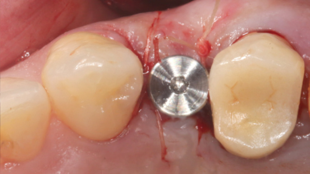 patient's final restoration