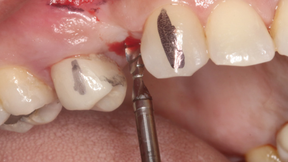 2.4-mm-diameter pilot drill is used on the site for depth and angulation of the implant osteotomy