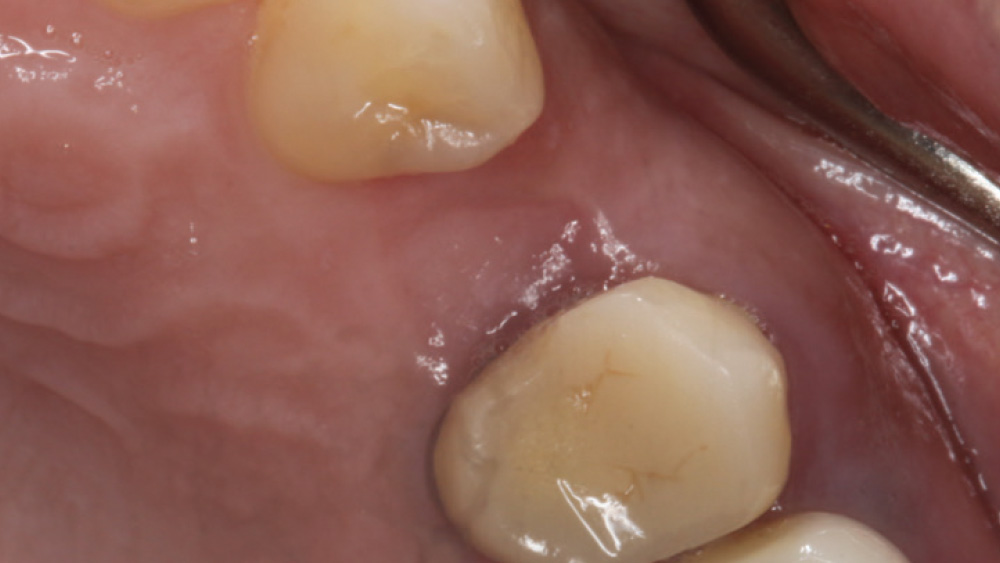 soft tissue exposing available bone