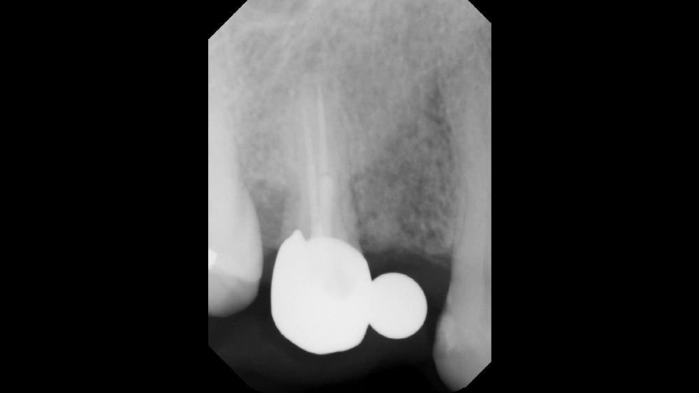 CBCT analysis of edentulous sites